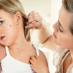 Salud – Brote de varicela y papera en Sastre