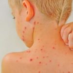 Por brotes de sarampión emiten una alerta epidemiológica